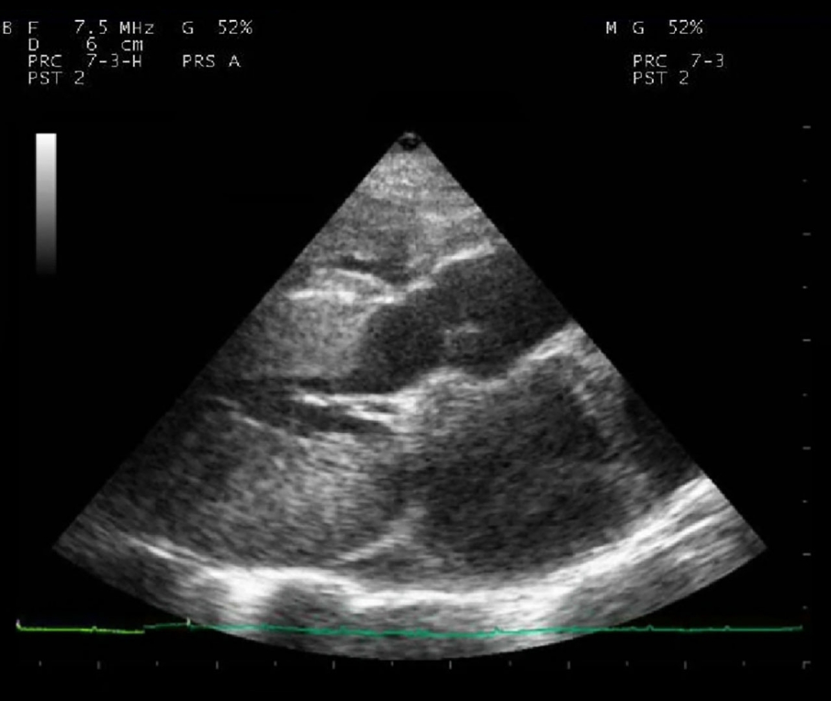 Feline Hypertrophic Cardiomyopathy Symptoms and Diagnosis HCM Felina