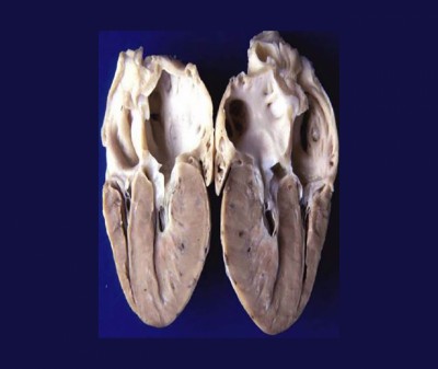 HCM reperto anatomopatologico 1